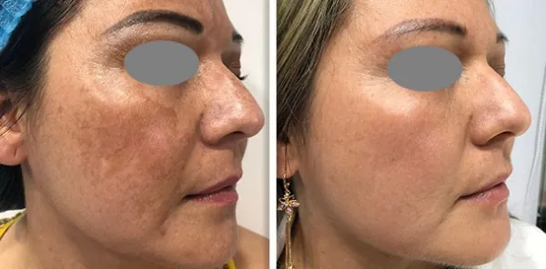 Antes y después, melasma facial